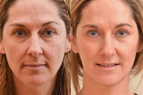 Laser Skin Resurfacing .